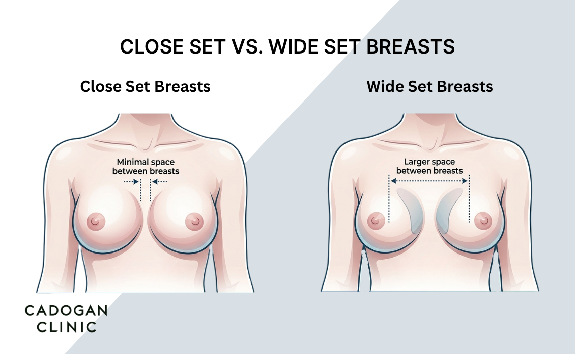 An infographic showing the difference between close set breasts and wide set breasts